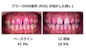 プラークの付着率(PCR)が減少した例1-1