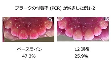 プラークの付着率(PCR)が減少した例2