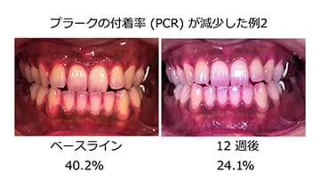 プラークの付着率(PCR)が減少した例2